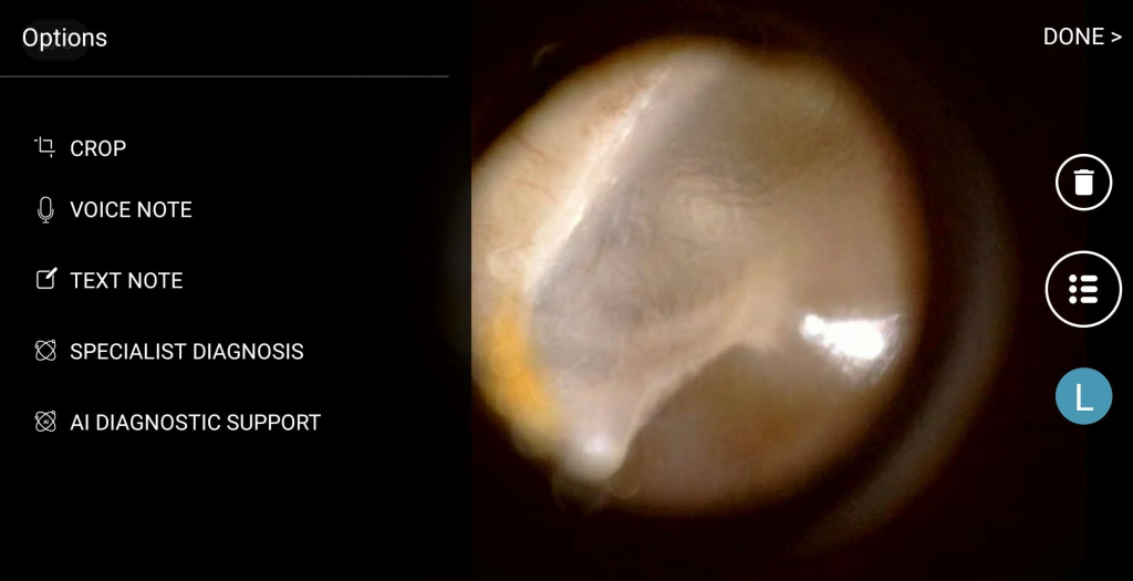 Smartphone screen displaying the hearScope app with a clear image of an eardrum and ear canal.

